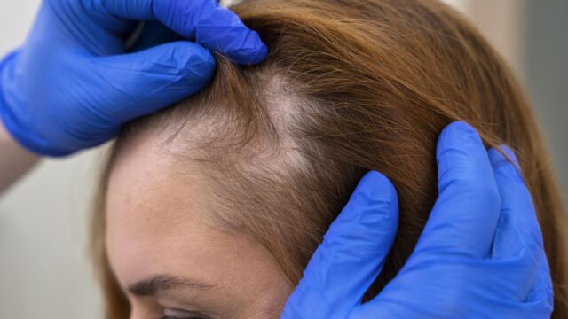 Queda de cabelo exige diagnóstico antes do tratamento, alerta tricologista sobre os tipos de alopecia