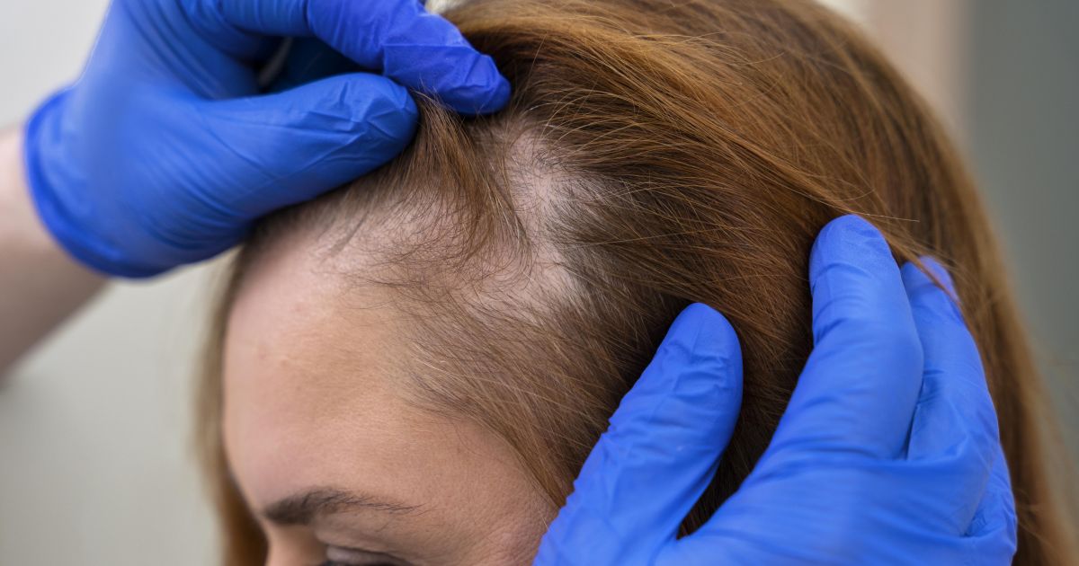 Queda de cabelo exige diagnóstico antes do tratamento, alerta tricologista sobre os tipos de alopecia