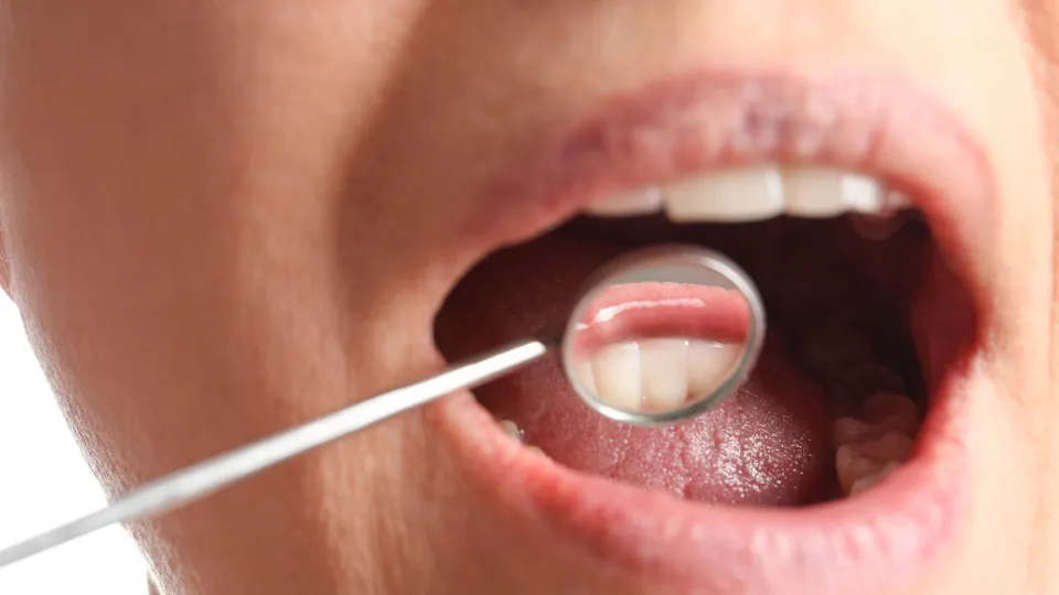 Tártaro nos dentes: por que algumas pessoas acumulam mais do que outras, segundo dentista